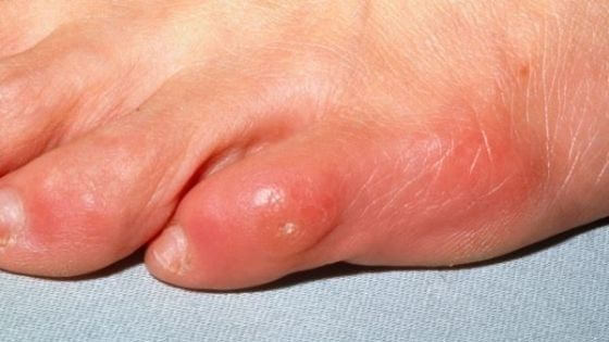 Types of calluses