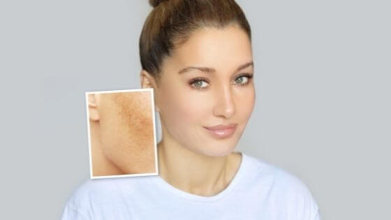 How to remove a dark spot