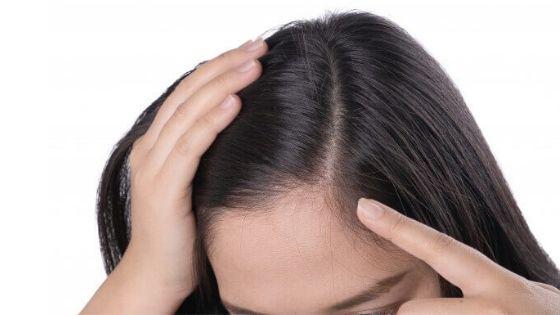 Thinning hair in woman