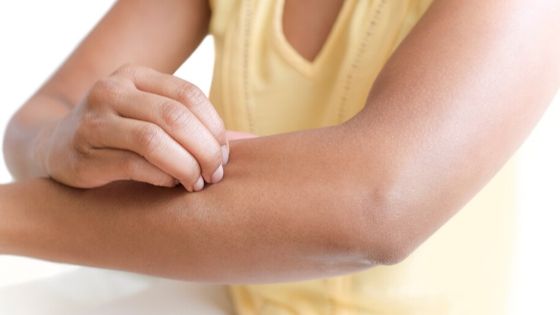 how to get rid of eczema naturally 
