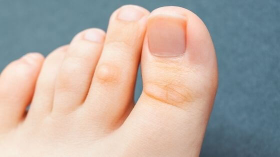 How to remove calluses on toes