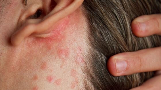 stress and anxiety cause rashes