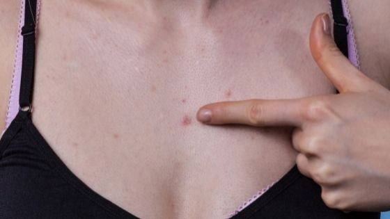 Why do I have pimples on my chest?