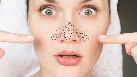 What are blackheads?