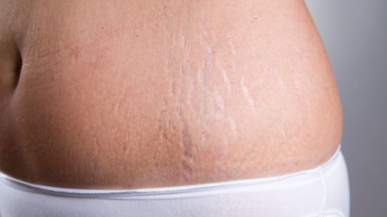 are stretch marks common