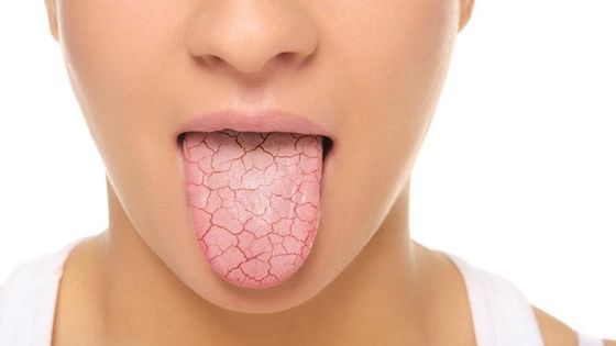 what-causes-extremely-dry-mouth-while-sleeping-dental-blog