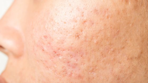 red acne scars